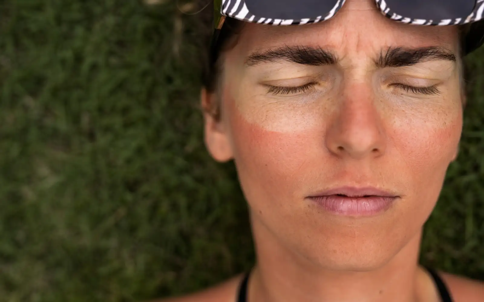 Солнечный ожог.